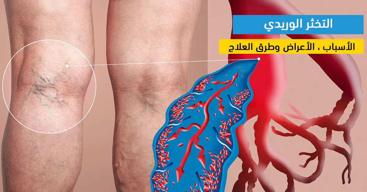 التخثر الوريدي : الأسباب ، الأعراض وطرق العلاج